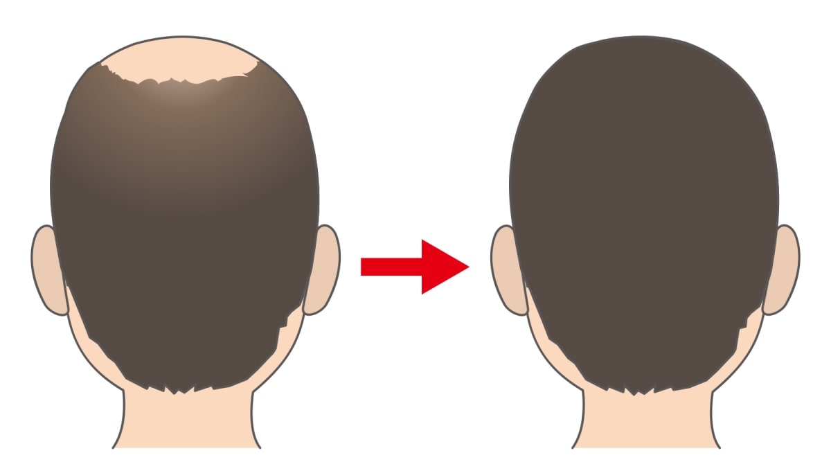 【AGA改善】ダーマローラーとミノキシジルの効果と副作用を徹底解説！